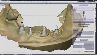 Part1 : Making a hybrid from an existing Denture