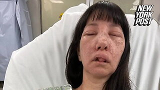 Atlanta mom suffers horrific injuries after being attacked by cluster of deadly spiders: Skin felt 'on fire'