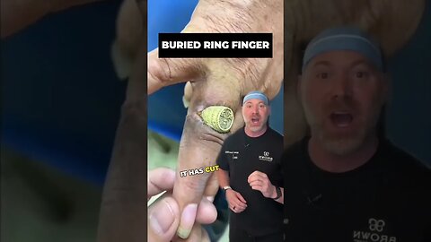 Ring Buried In Finger?! 😱 #shorts