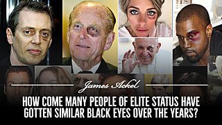 How come many people of elite status have gotten similar black eyes over the years?👀