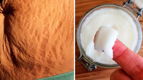 How to Get Rid of Stretch Marks Naturally