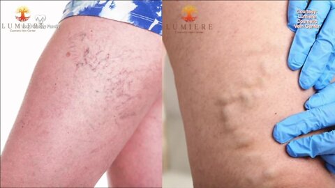 Your Healthy Family: Spider & varicose veins could be sign of deeper health issue
