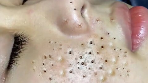 Compilação Cravos, Espinhas e Cistos - Squeezing Blackheads and Pimples - Just Relax | Apenas Relaxe