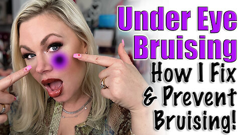 Under Eye Bruising : How I Fix + Prevent Bruising | Code Jessica10 saves you Money Approved Vendors