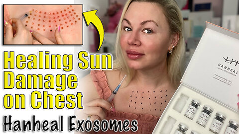 Healing Sun Damage with Exosome Chest Meso Therapy, AceCosm | Code Jessica10 Saves you Money