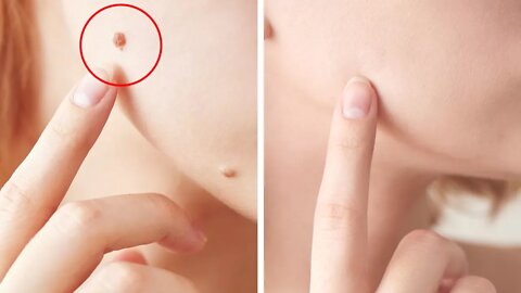How to Get Rid of Skin Moles at Home Naturally