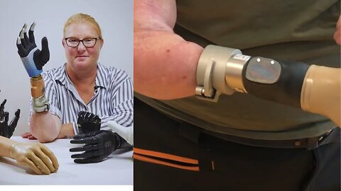 The real bionic woman becomes first human to receive a robotic limb