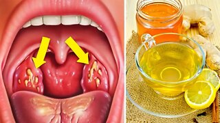 How to Cure Tonsillitis Fast and Naturally