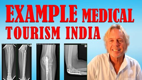 Medical Tourism Example in Goa India, as Doctor Removes Pins from Broken Leg, Arm