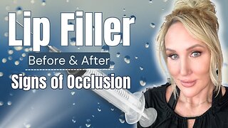 Lip Filler Before & After // Signs of Occlusion