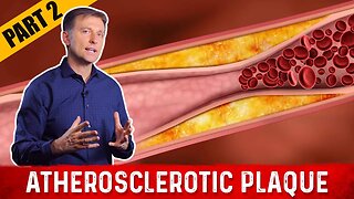What Is Atherosclerosis Plaque? – Dr.Berg on Cholesterol Levels (Part-2)