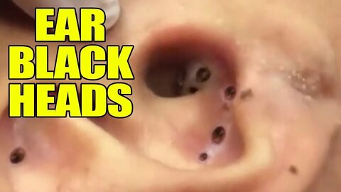 Ear Blackhead professional extraction l Cravo Acne