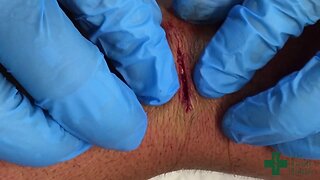 Removal of a Longstanding Wart with Dermal Sutures