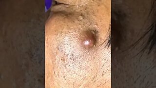 Remoção de Cravos e Espinhas - Remove Squeezing Blackheads and Pimples - Just Relax | Apenas Relaxe