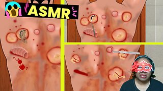 ASMR Back Acne Popping And Big Pustules Removal - Satisfying Cupping Therapy