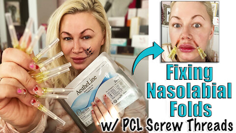 Fixing Nasolabial Folds with PCL Screw Threads from Acecosm.com | Code Jessica10 Saves you Money!