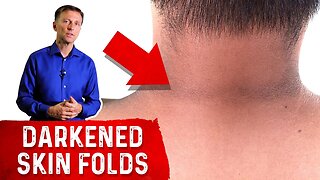 How to Reverse Acanthosis Nigricans