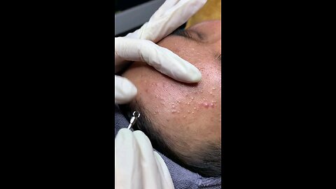 Blackheads episode 60