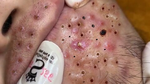 Removing Acne and Blackheads Treatment, #38