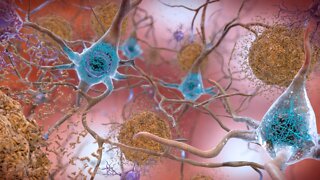 Study: New Drug Appears To Slow Alzheimer's