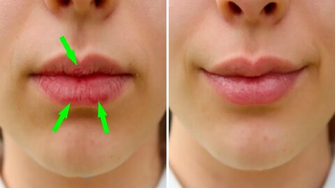 Here's How To Heal Your Dry, Chapped Lips Naturally