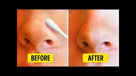 9 Natural Ways to Get Rid of Blackheads on Nose