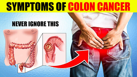 Critical Colon Cancer Symptoms You Should Never Ignore