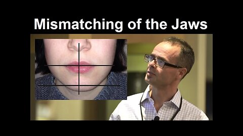 Effect of Midline Discrepancy, Mismatching or Facial Asymmetry on Facial Appearance by Dr Mike Mew