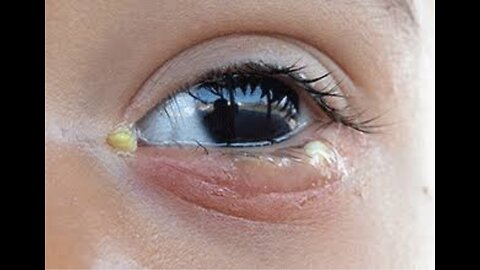 How To Cure "CONJUNCTIVITIS" ( Eye Infection ) Or Pink Eye ..