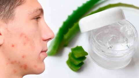 How to Make Your Own Acne Gel That Actually Works