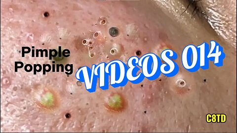 Satisfying Pimple Popping Videos 014