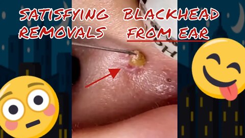 Satisfying blackhead removing from ear 👂 #blackheadremoval #blackhead #blackheads #whiteheads