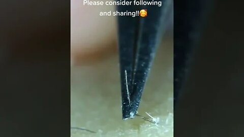 Double Ingrown Hair Removal