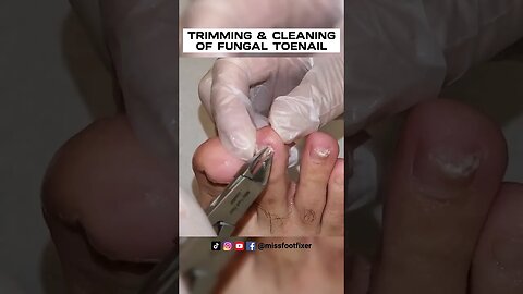 TRIMMING & CLEANING OF FUNGAL TOENAIL 2023 [ SATISFYING ] BY FOOT DOCTOR MISS FOOT FIXER