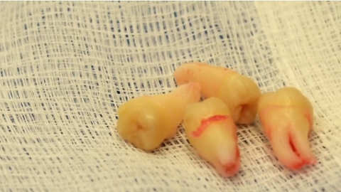 The Real Reason We Humans Still Have "Wisdom" Teeth