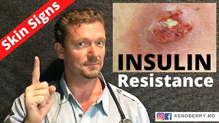 7 Skin Signs of INSULIN RESISTANCE (Root Cause 2021) WARNING: Graphic