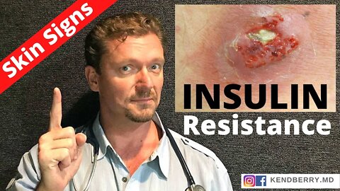 7 Skin Signs of INSULIN RESISTANCE (Root Cause 2021) WARNING: Graphic