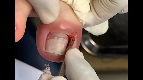 Removendo a unha encravada em tempo recorde: veja como! #ingrown_toenail #unhaencravada #podologia