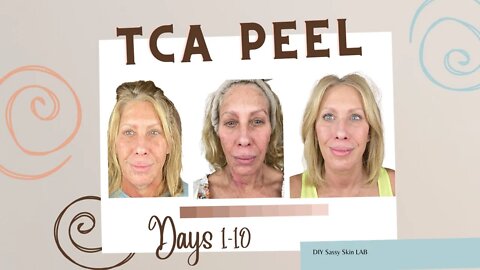 TCA Peel Day 1-11 🤗 How Does Your Skin Look While Peeling?