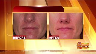 Treating Rosacea and Protecting Your Skin
