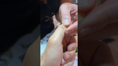 Draining a ganglion cyst