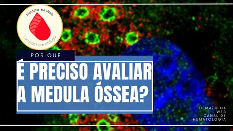 Para que serve a avaliação de medula óssea? [Nem sempre é leucemia!] | Geydson Cruz; MD,MSc