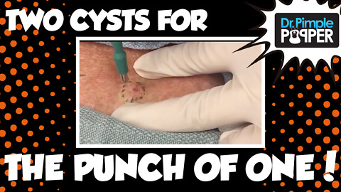 2 Cysts, 1 Punch with Dr. Pimple Popper