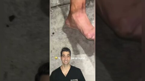 Severely Crooked Toe Correction