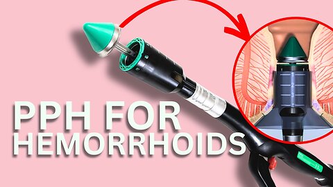 PPH hemorrhoid surgery | Dr. Chung explains!