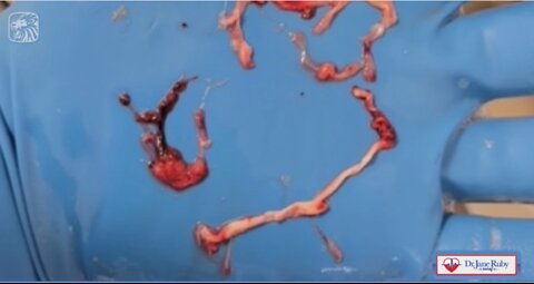 Embalmers Find Veins and Arteries Filled with Never Before Seen Rubbery Clots in Dead Vaxxed People