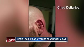 Police: Little League coach attacked with aluminum baseball bat