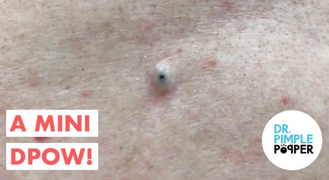 Another Mini One..Dilated Pore of Winer