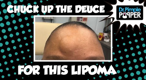 Chunk (Or Chock) Up the Deuce for this Lipoma ✌🏼