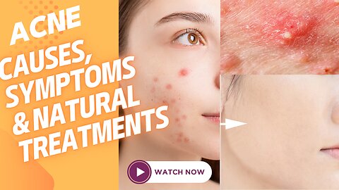 What Acne, Causes, Symptoms and Herbal Treatments | Acne | Face Fresh | herbal Treatments |